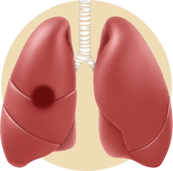 Stage 1 treatment process illustration