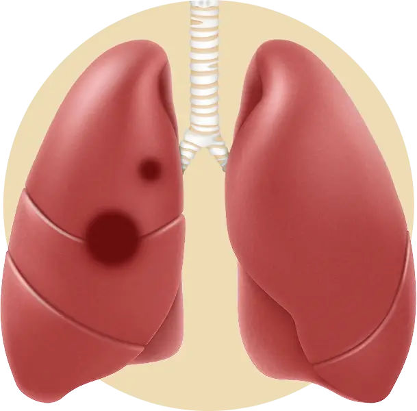 Stage 2 treatment process illustration