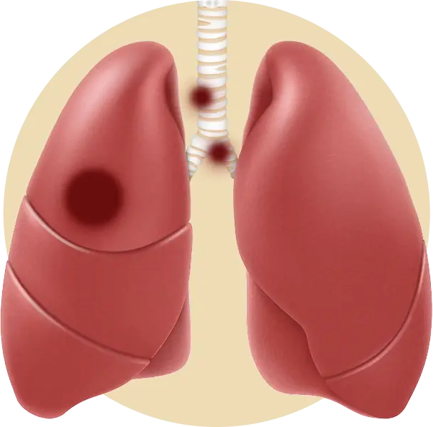 Stage 3 treatment process illustration