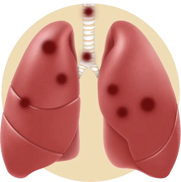Stage 4 treatment process illustration